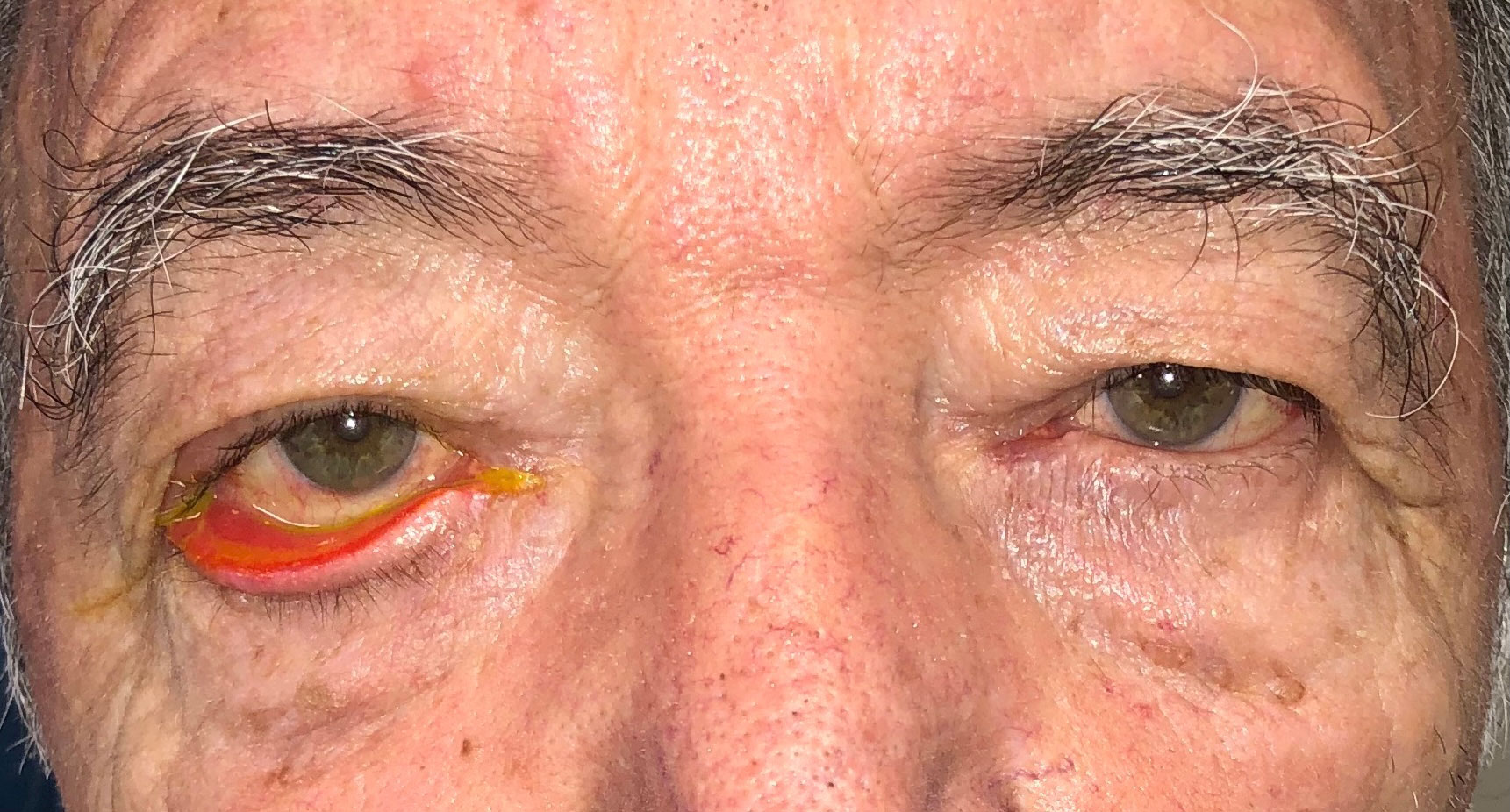 Ptosis adquirida