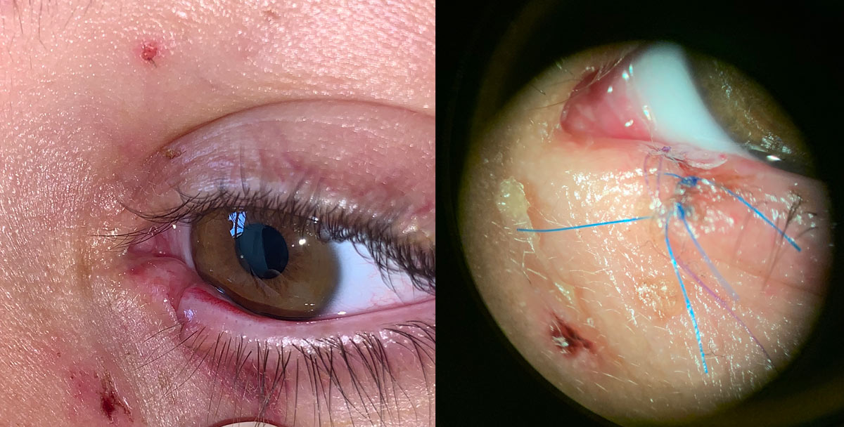 Trauma palpebral con comprmiso de canalículo reparado con
intubación de la vía lagrimal