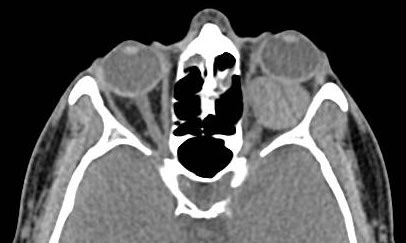 Tomografía computada que muestra tumor orbitario izquierdo